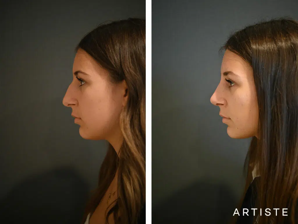 17 Years Old: Open Structure Rhinoplasty