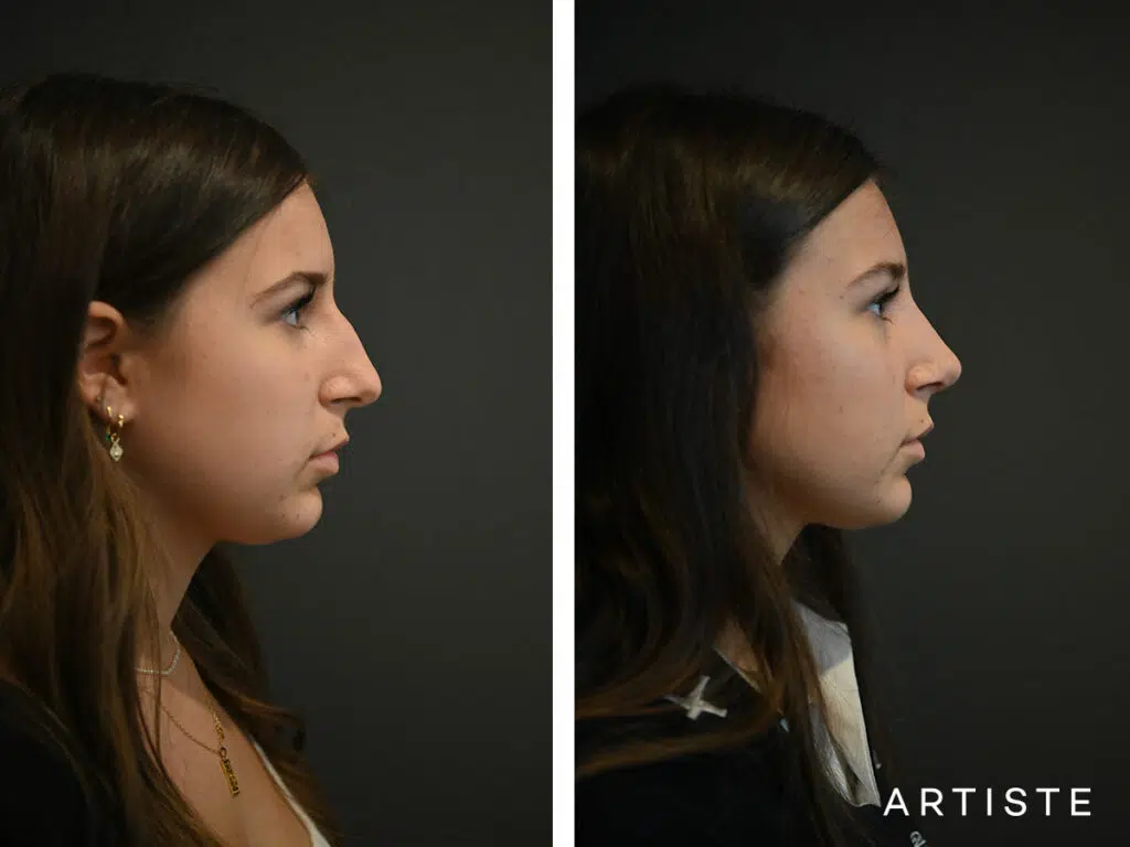 17 Years Old: Open Structure Rhinoplasty