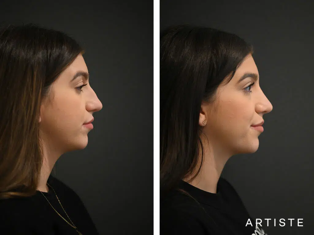 24 Years Old: Open Rhinoplasty