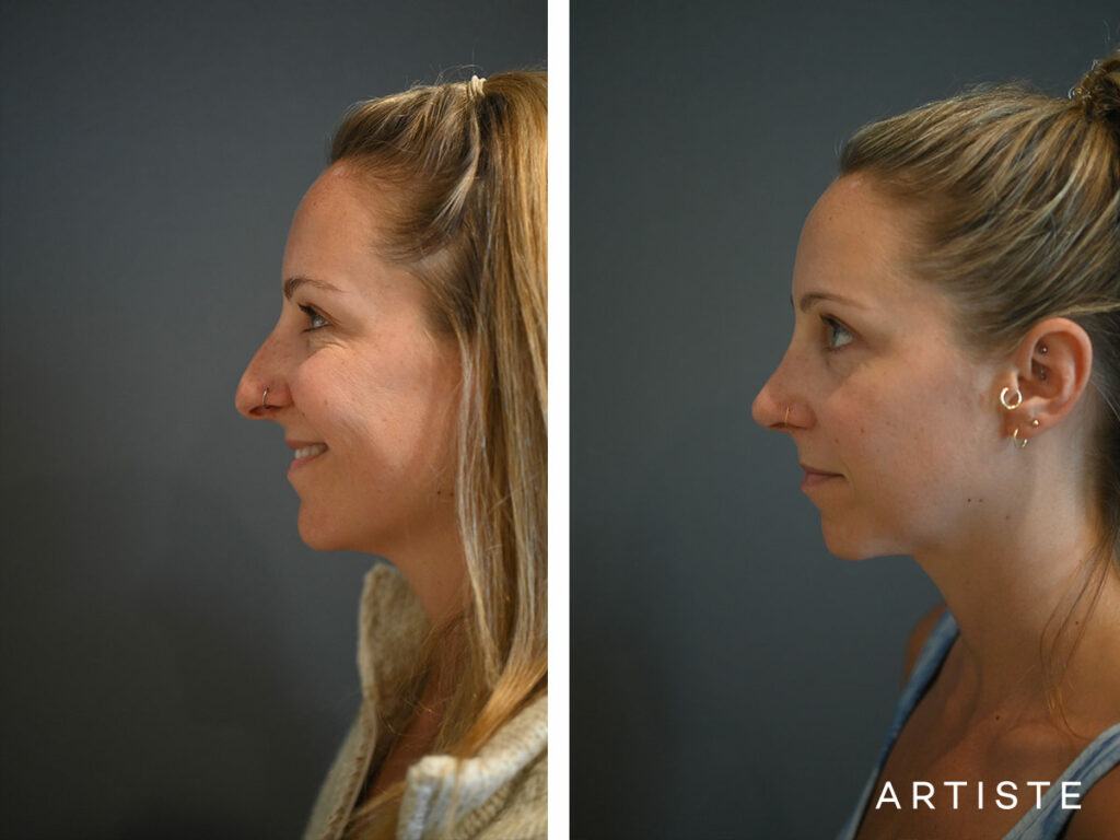 32 Years Old: 6 months Post Open Structure Rhinoplasty