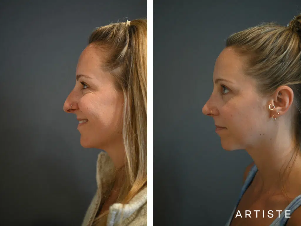 32 Years Old: 6 months Post Open Structure Rhinoplasty