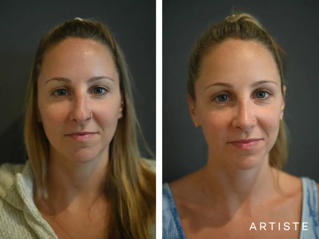 32 Years Old: 6 months Post Open Structure Rhinoplasty