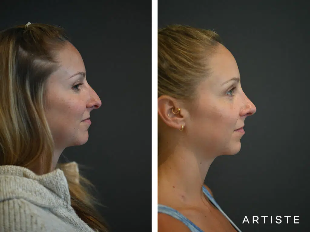 32 Years Old: 6 months Post Open Structure Rhinoplasty