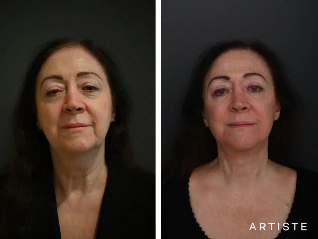 Deep Plane Face and neck lift, upper eyelid blepharoplasty pictured 7 months
