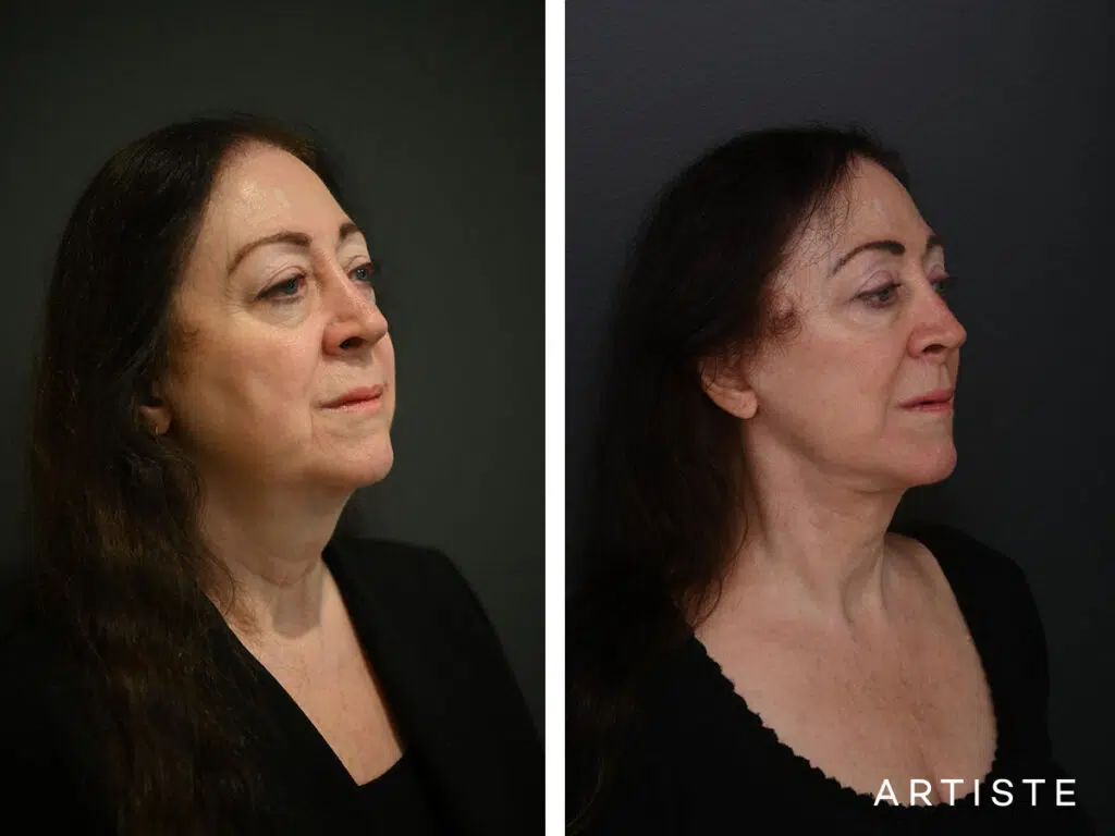 Deep Plane Face and neck lift, upper eyelid blepharoplasty pictured 7 months
