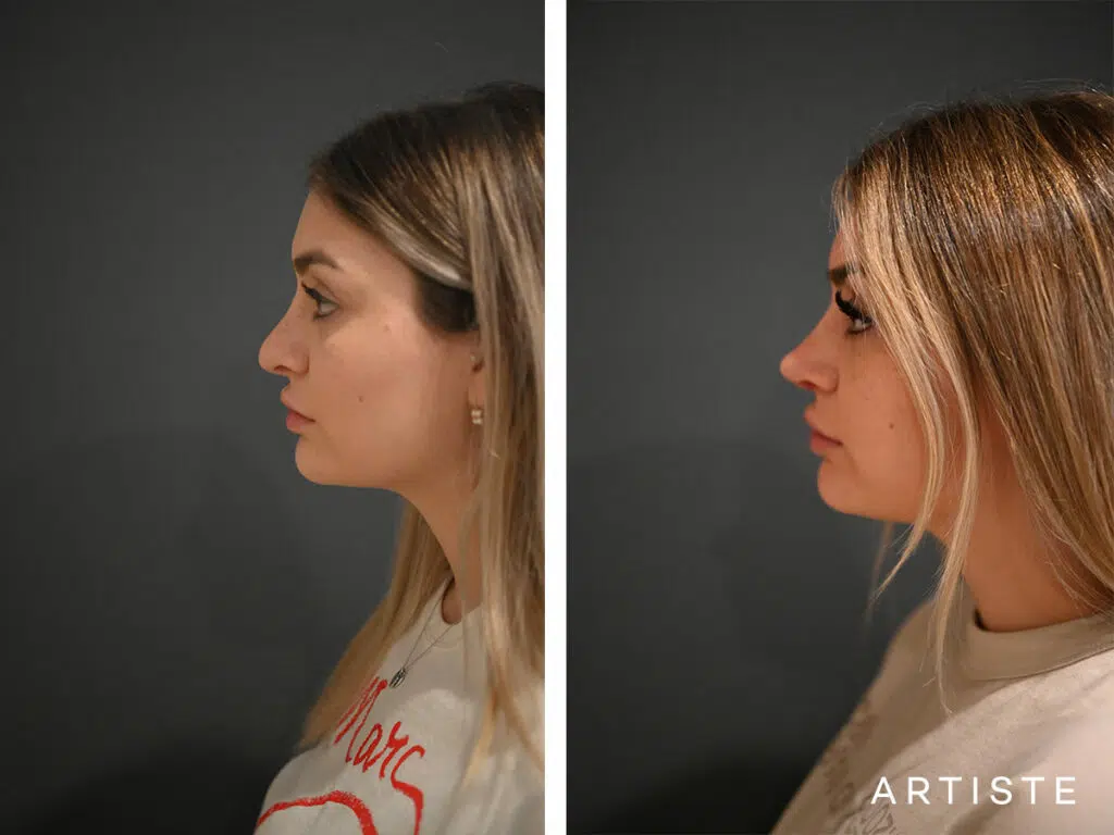 21 Years Old: Rib Graft Revision Rhinoplasty