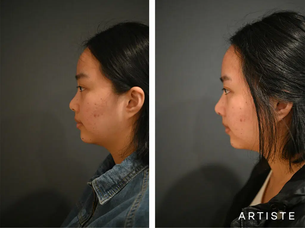 21 Years Old: Rib Graft Augmentation Rhinoplasty