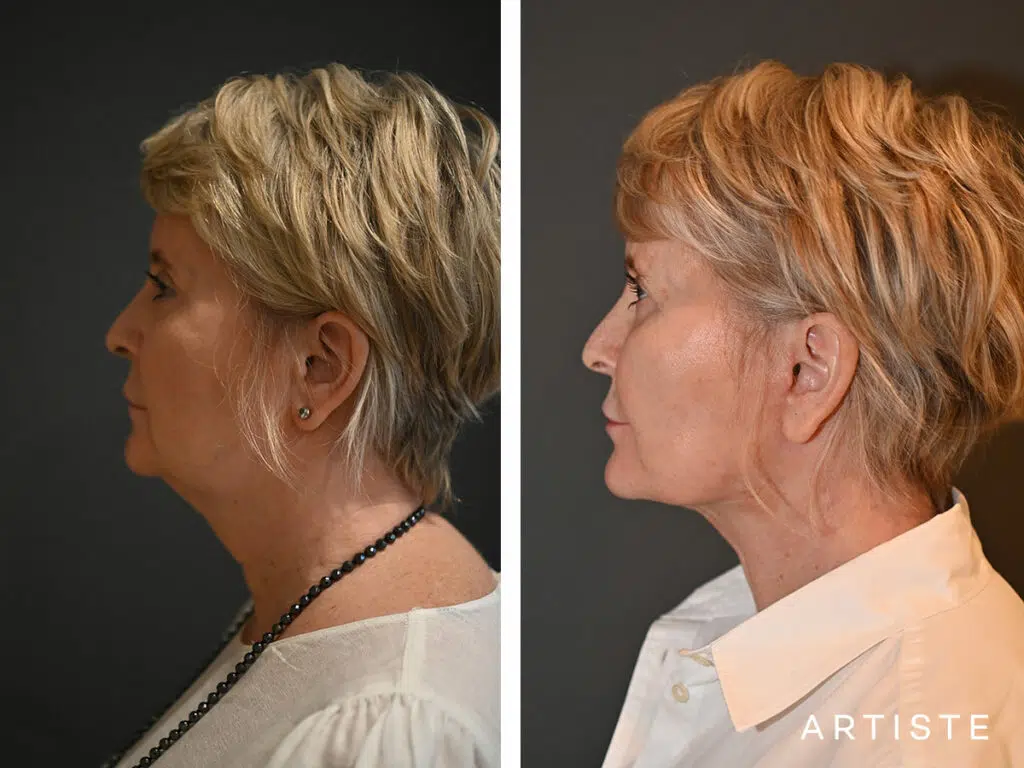 57 Years Old: Deep Plane Neck Lift