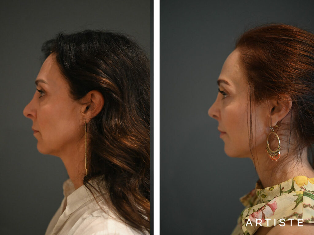 44 Years Old: Deep Plane Facelift, Micro Fat Grafting, Lower Eyelid Blepharoplasty and Revision Rib Graft Rhinoplasty
