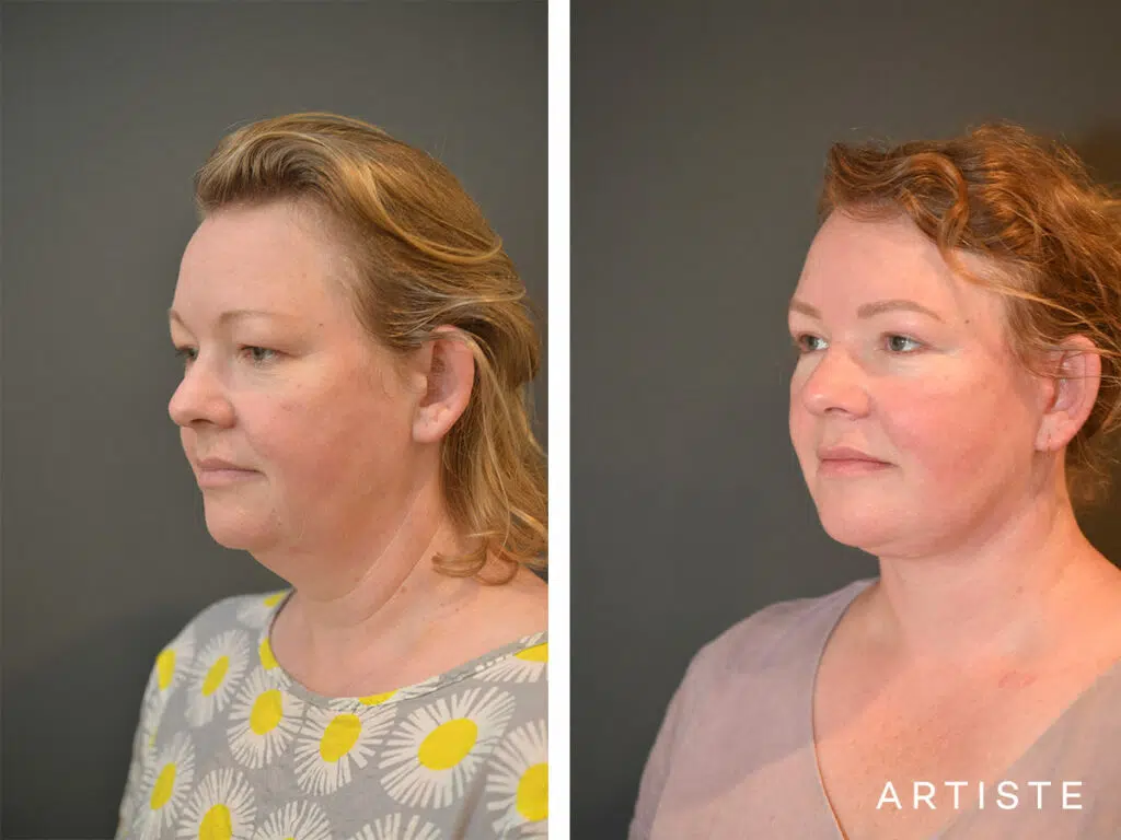 42 Years Old: Deep Plane Face and Neck Lift and Upper Eyelid Blepharoplasty