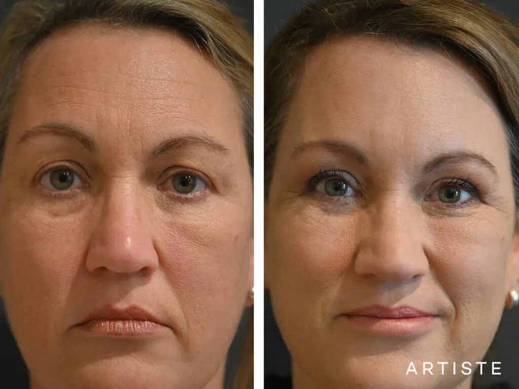 52 Years Old: Lower Eyelid Blepharoplasty