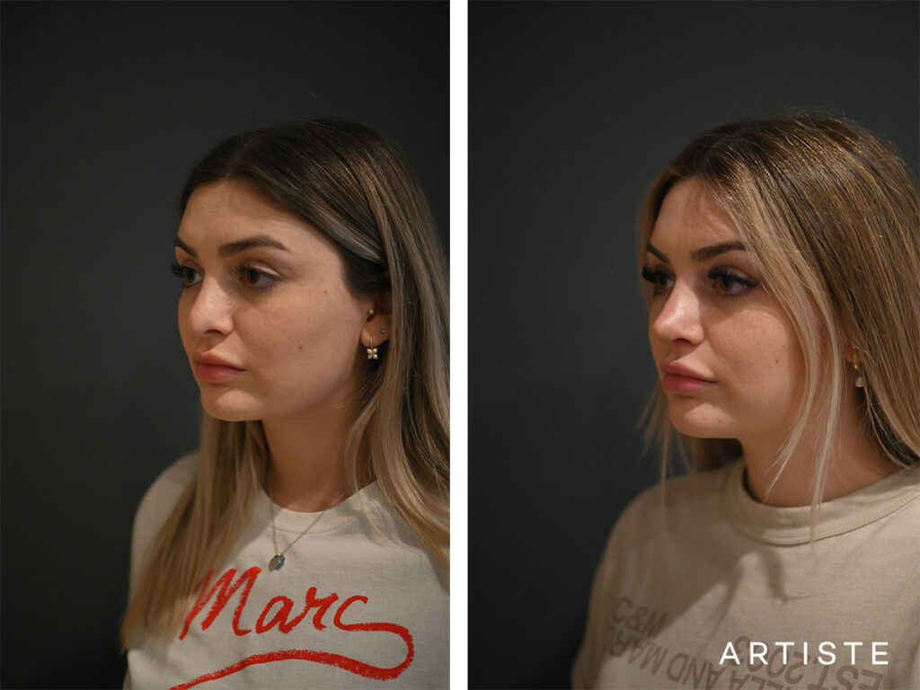 21 Years Old: Rib Graft Revision Rhinoplasty