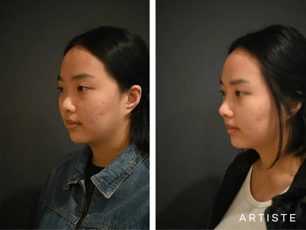 21 Years Old: Rib Graft Augmentation Rhinoplasty