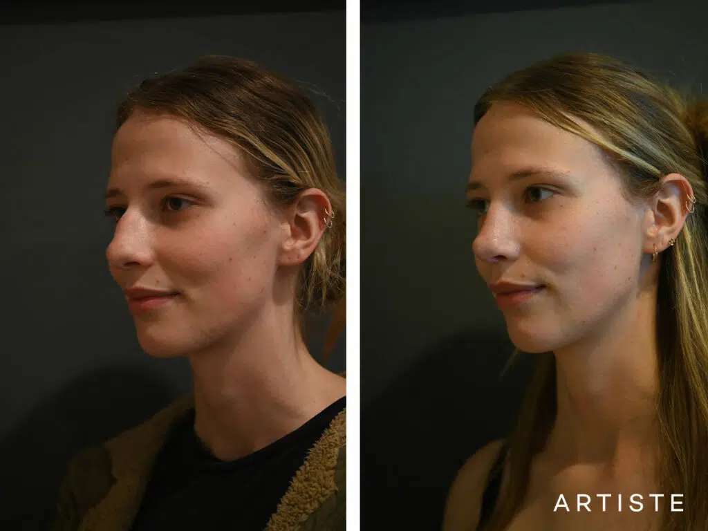 20 Years Old: 6 months Post Open Structure Rhinoplasty