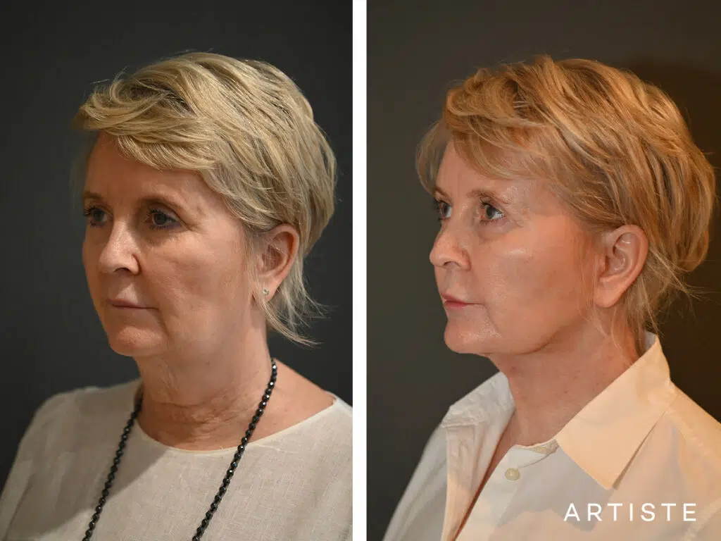 57 Years Old: Deep Plane Neck Lift