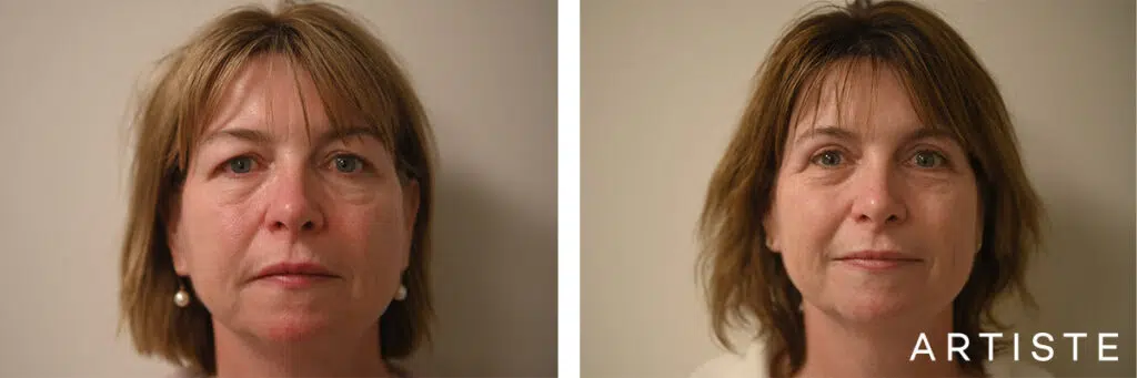 52 Years Old: Upper Eyelid Blepharoplasty