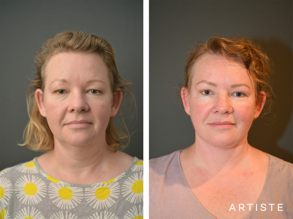 42 Years Old: Deep Plane Face and Neck Lift Surgery and Upper Eyelid Blepharoplasty