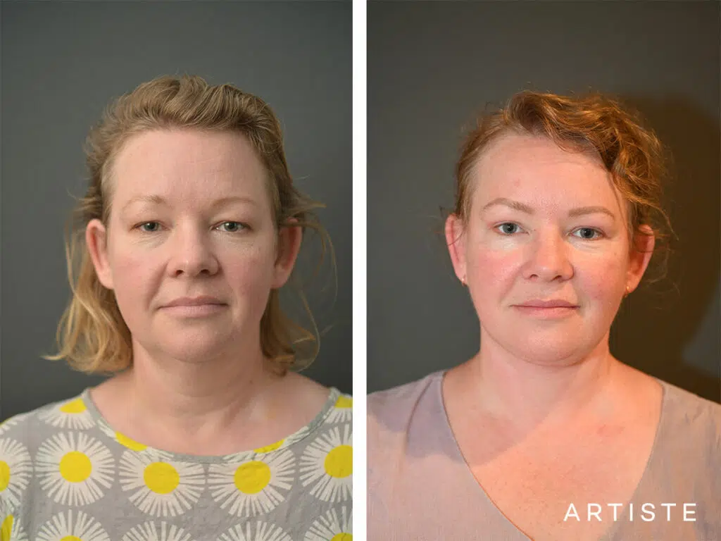 42 Years Old: Deep Plane Face and Neck Lift and Upper Eyelid Blepharoplasty