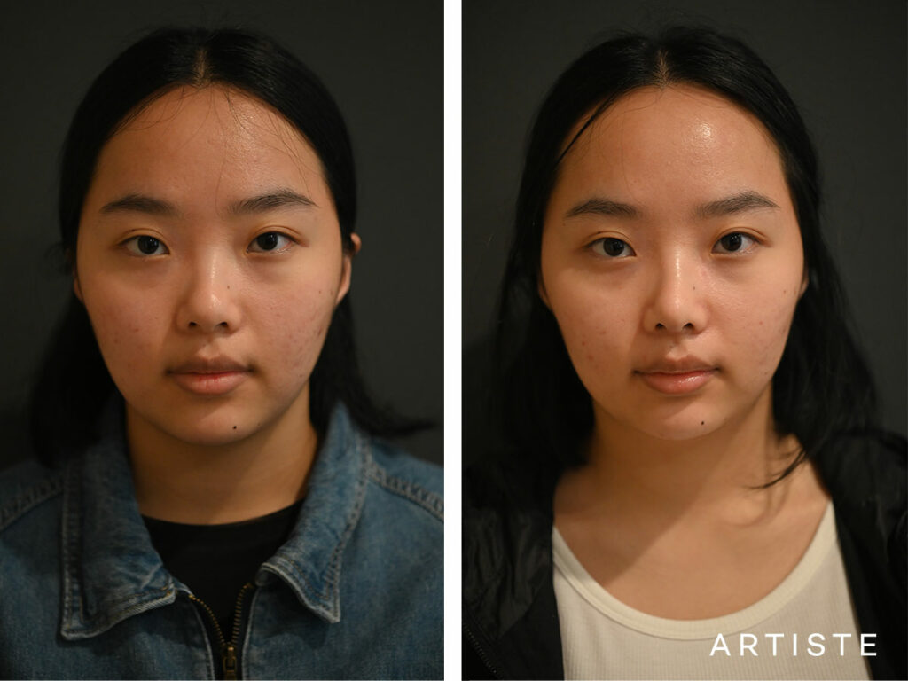 21 Years Old: Rib Graft Augmentation Rhinoplasty