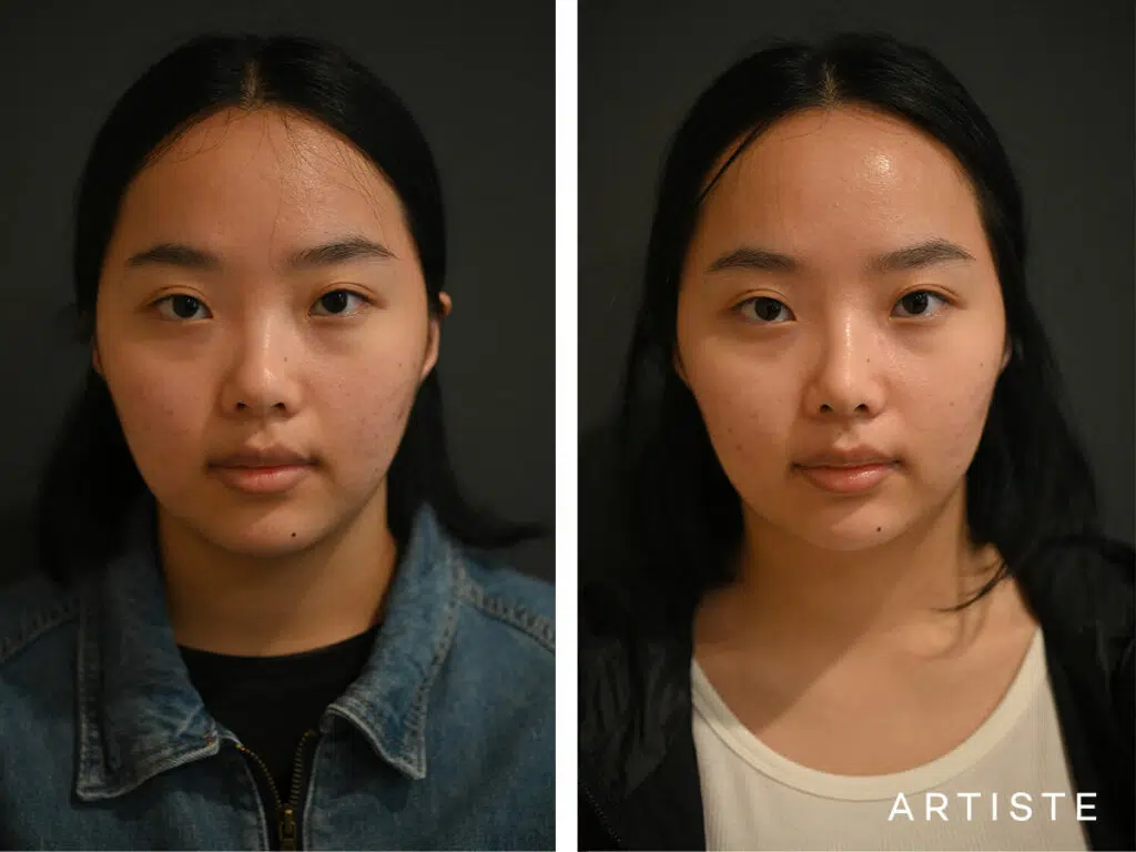 21 Years Old: Rib Graft Augmentation Rhinoplasty