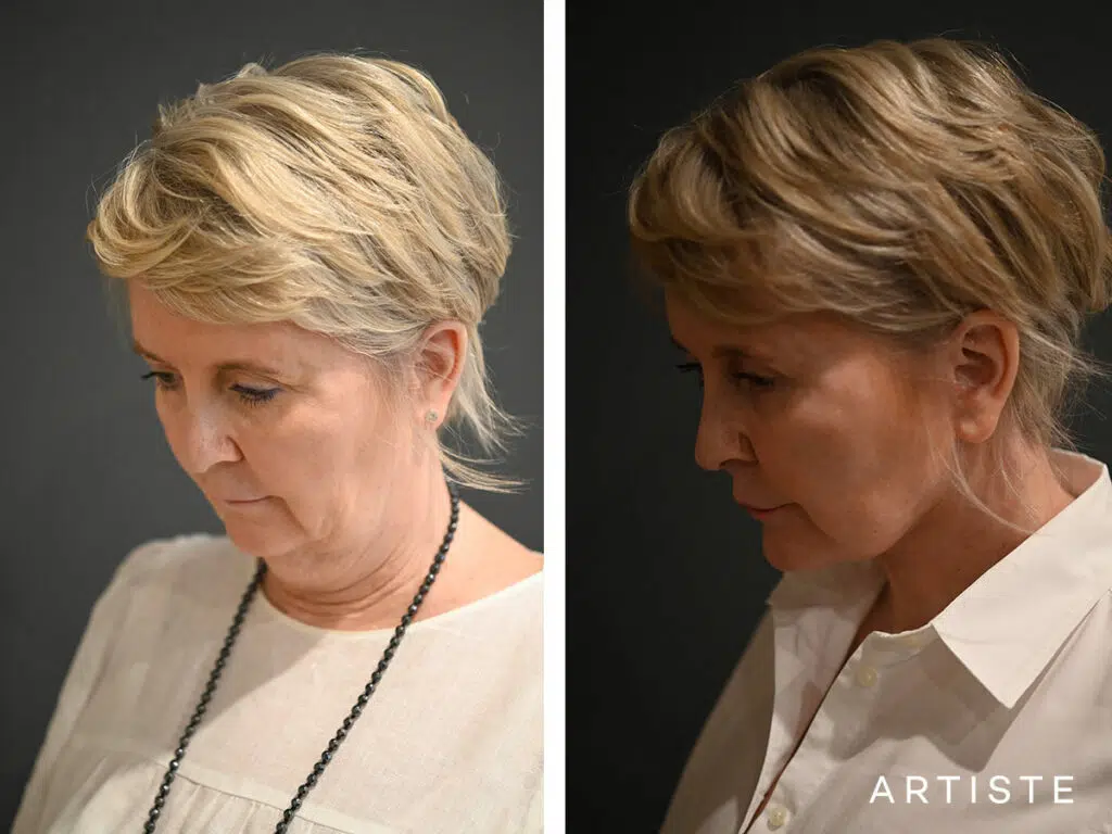 57 Years Old: Deep Plane Neck Lift