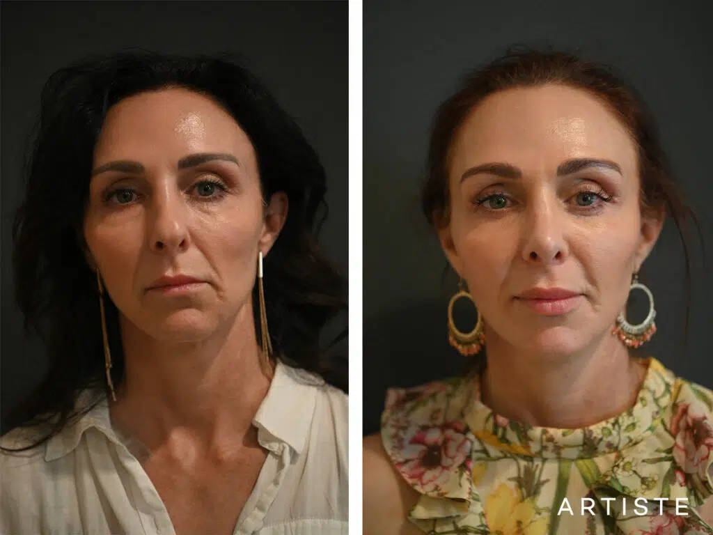 44 Years Old: Deep Plane Facelift, Micro Fat Grafting, Lower Eyelid Blepharoplasty and Revision Rib Graft Rhinoplasty