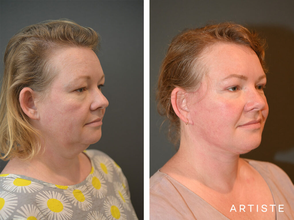 42 Years Old: Deep Plane Face and Neck Lift Surgery and Upper Eyelid Blepharoplasty