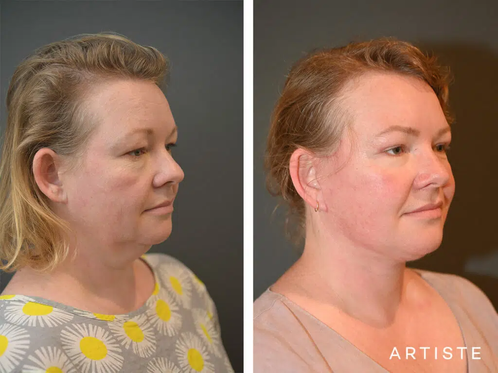 42 Years Old: Deep Plane Face and Neck Lift and Upper Eyelid Blepharoplasty