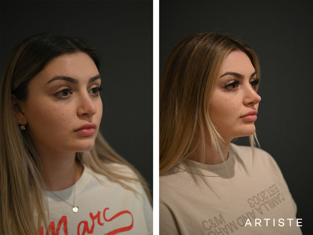 21 Years Old: Rib Graft Revision Rhinoplasty