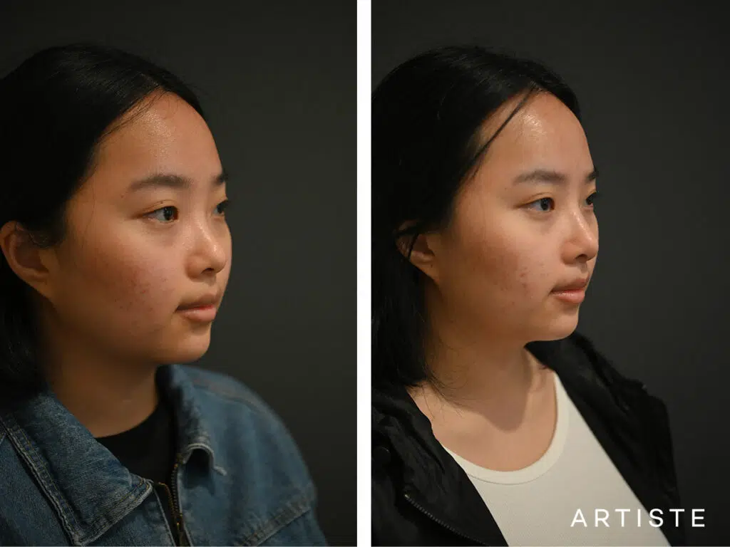 21 Years Old: Rib Graft Augmentation Rhinoplasty