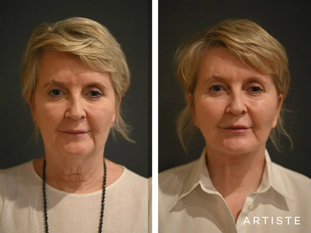 57 Years Old: Deep Plane Neck Lift