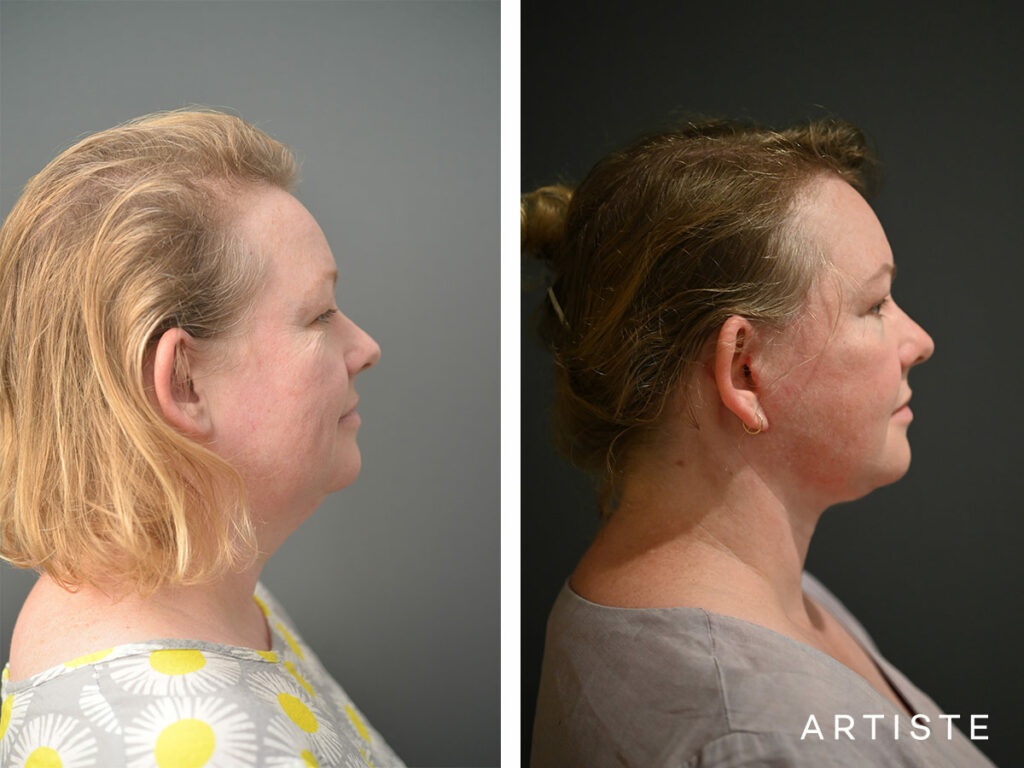 42 Years Old: Deep Plane Face and Neck Lift Surgery and Upper Eyelid Blepharoplasty