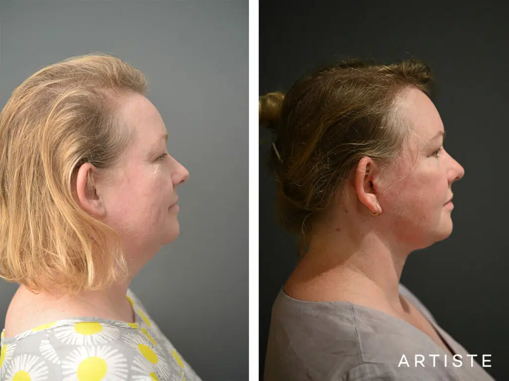 42 Years Old: Deep Plane Face and Neck Lift and Upper Eyelid Blepharoplasty