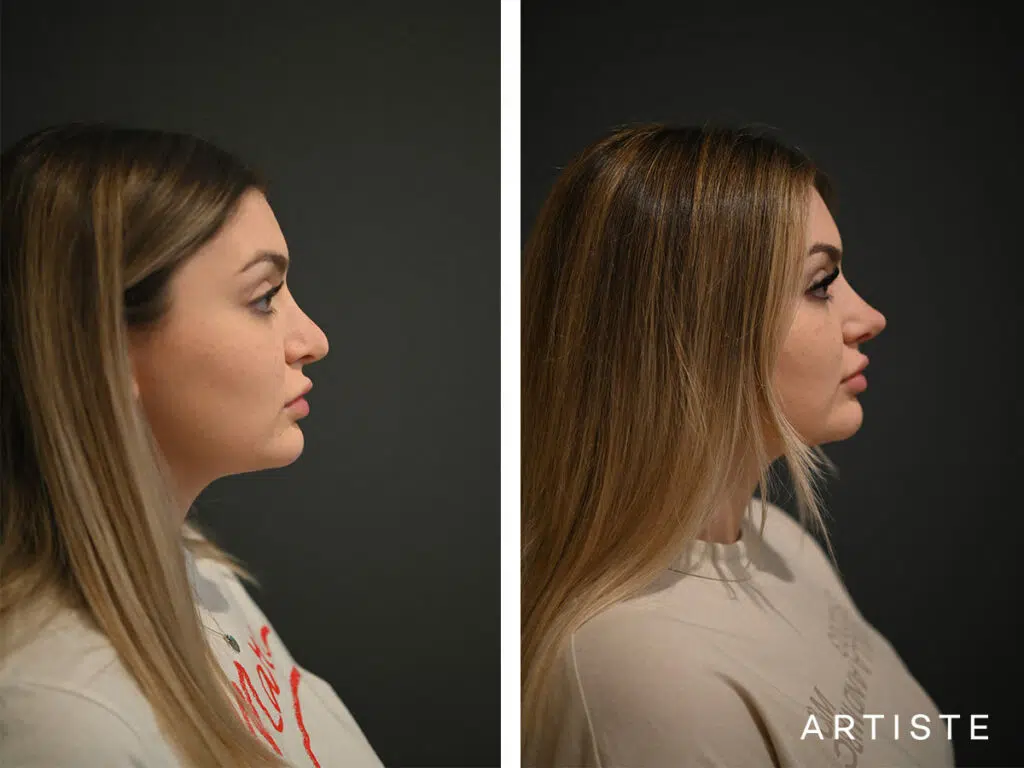 21 Years Old: Rib Graft Revision Rhinoplasty