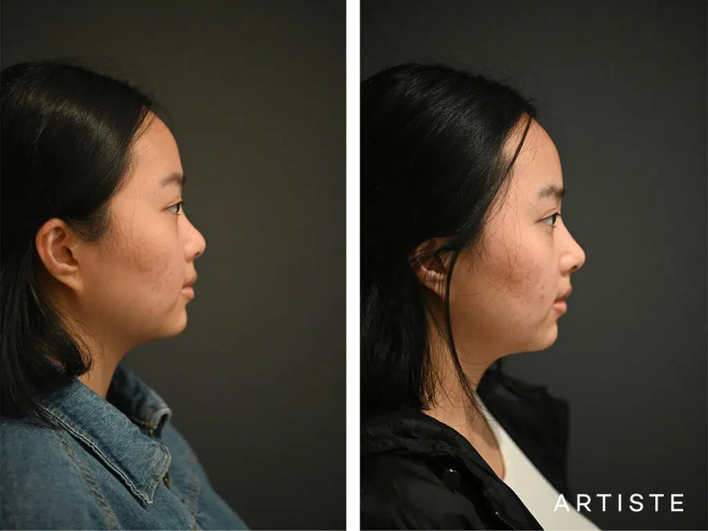 21 Years Old: Rib Graft Augmentation Rhinoplasty