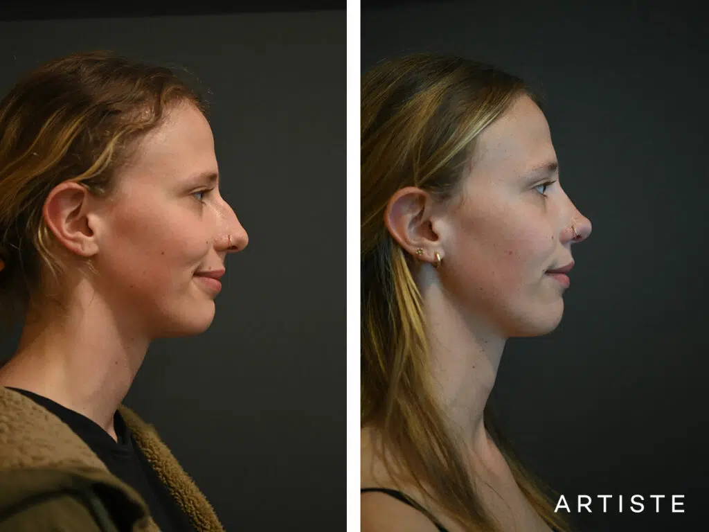 20 Years Old: 6 months Post Open Structure Rhinoplasty