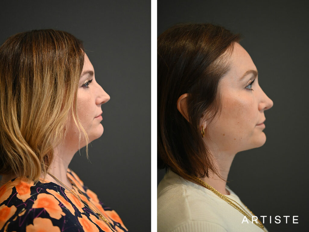 35 Years Old: Open Sturcture Rhinoplasty