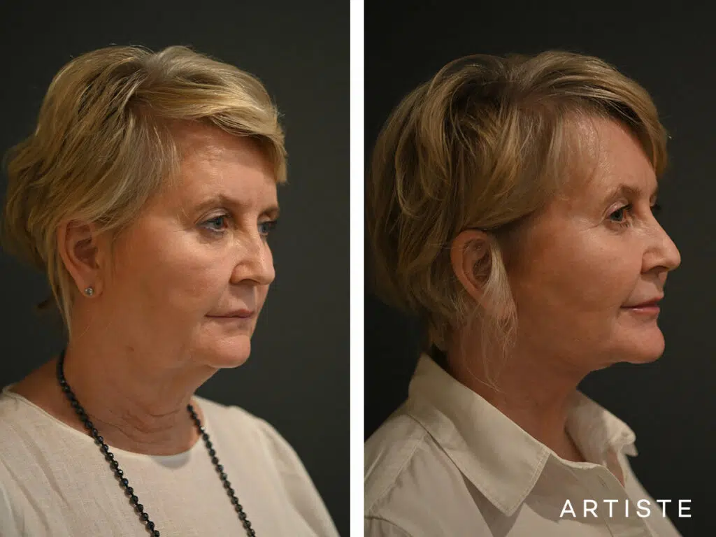 57 Years Old: Deep Plane Neck Lift