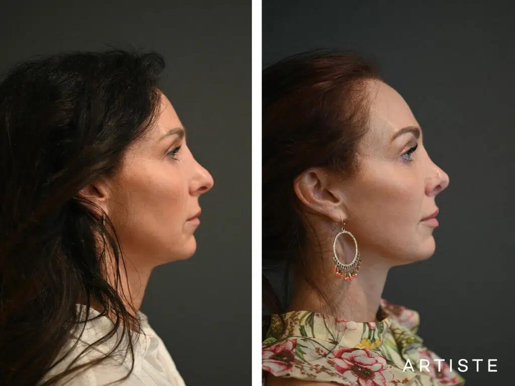 44 Years Old: Deep Plane Facelift, Micro Fat Grafting, Lower Eyelid Blepharoplasty and Revision Rib Graft Rhinoplasty