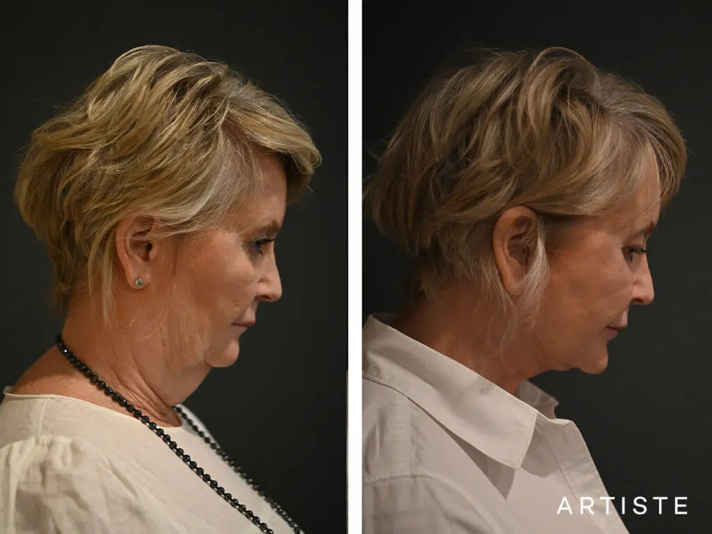 57 Years Old: Deep Plane Neck Lift