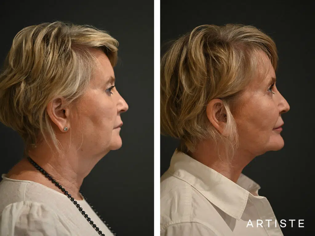 57 Years Old: Deep Plane Neck Lift