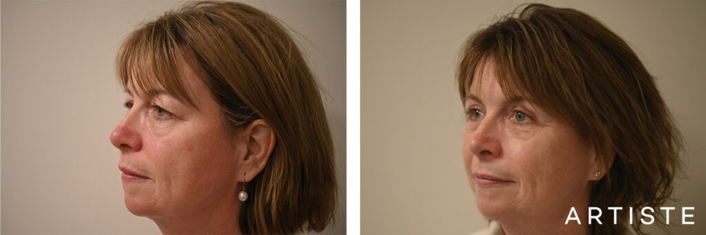 52 Years Old: Upper Eyelid Blepharoplasty