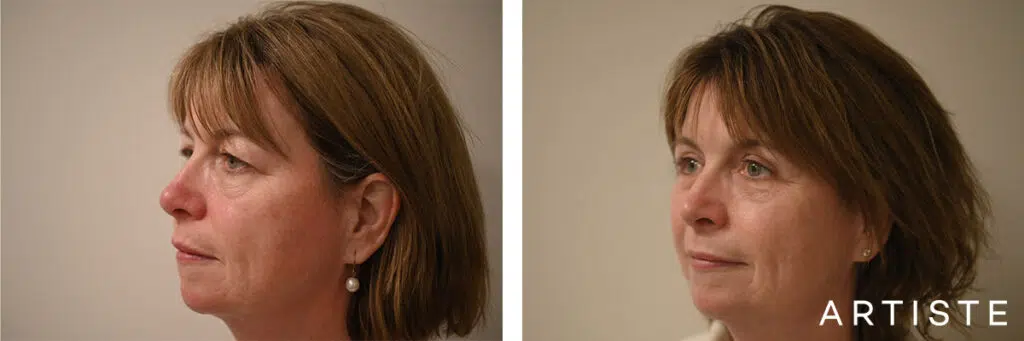 52 Years Old: Upper Eyelid Blepharoplasty