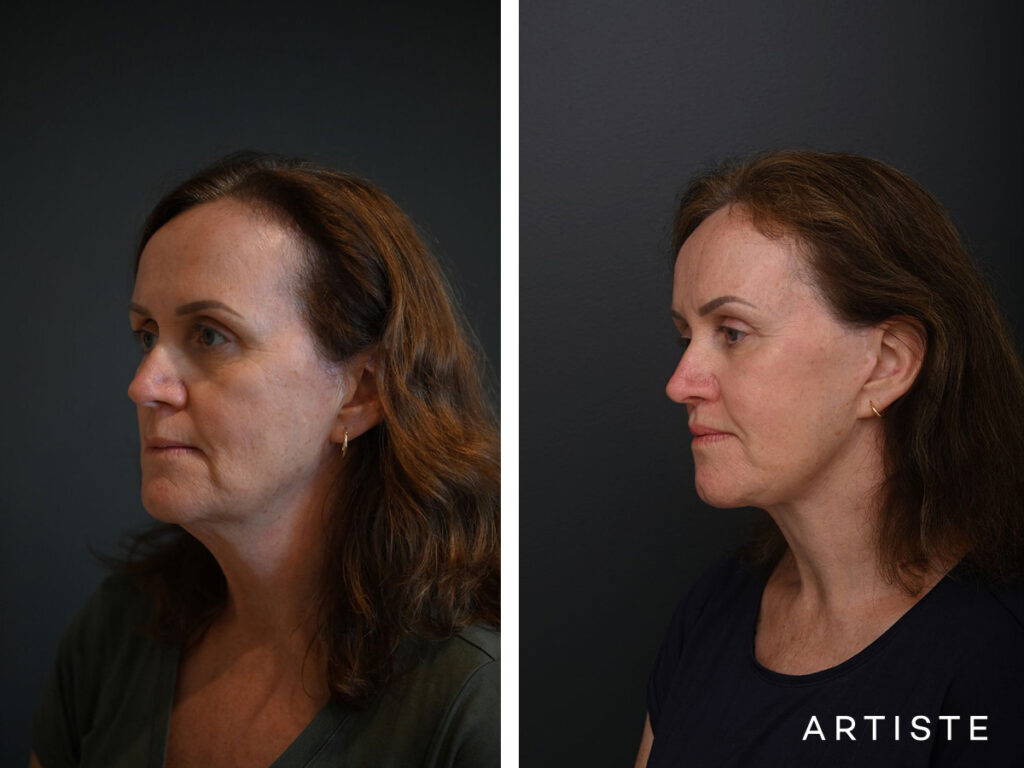 High SMAS Face and Neck Lift, Upper Eyelids, Brow Lift and Lip lift dermabrasion and peel 12 months post