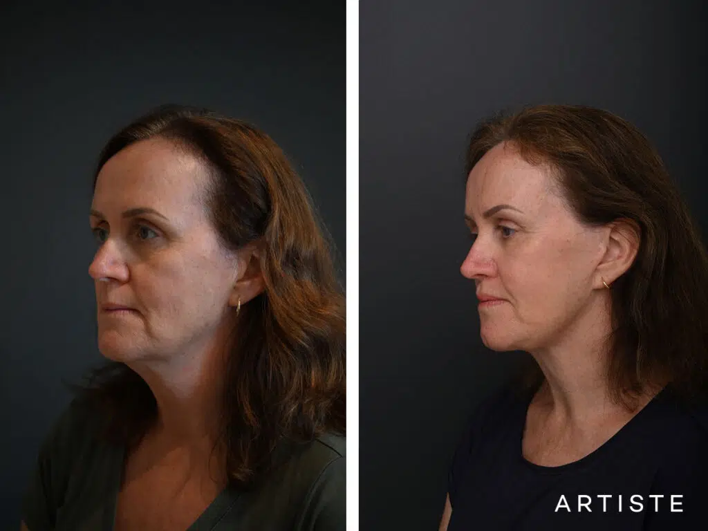 High SMAS Face and Neck Lift, Upper Eyelids, Brow Lift and Lip lift dermabrasion and peel 12 months post