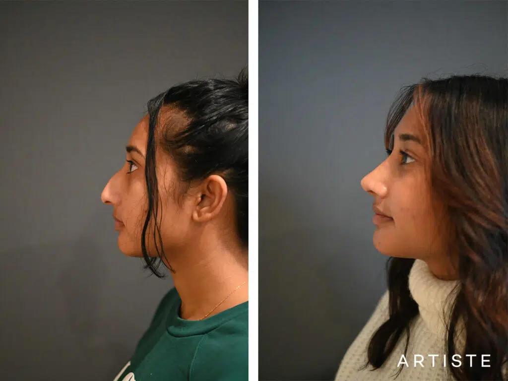 26 Years Old: Ethnic Open Structure Rhinoplasty