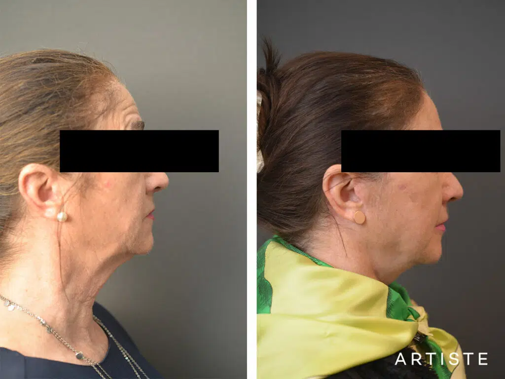 64 Years Old: High SMAS Face and Neck Lift, Micro Fat Grafting and Upper Eyelid Blepharoplasty