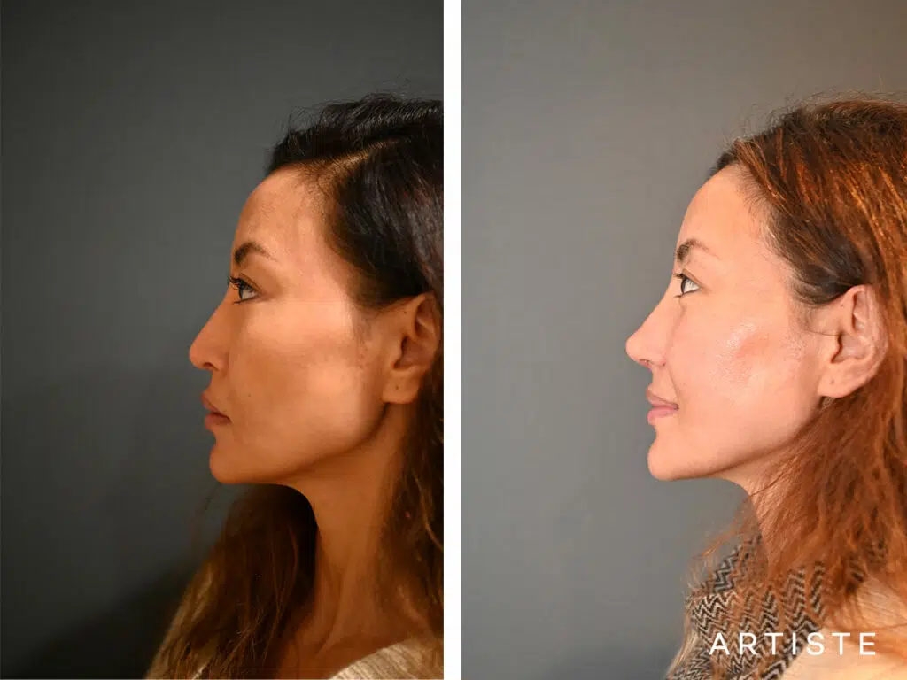 39 Years Old: Allograft Nose Augmentation