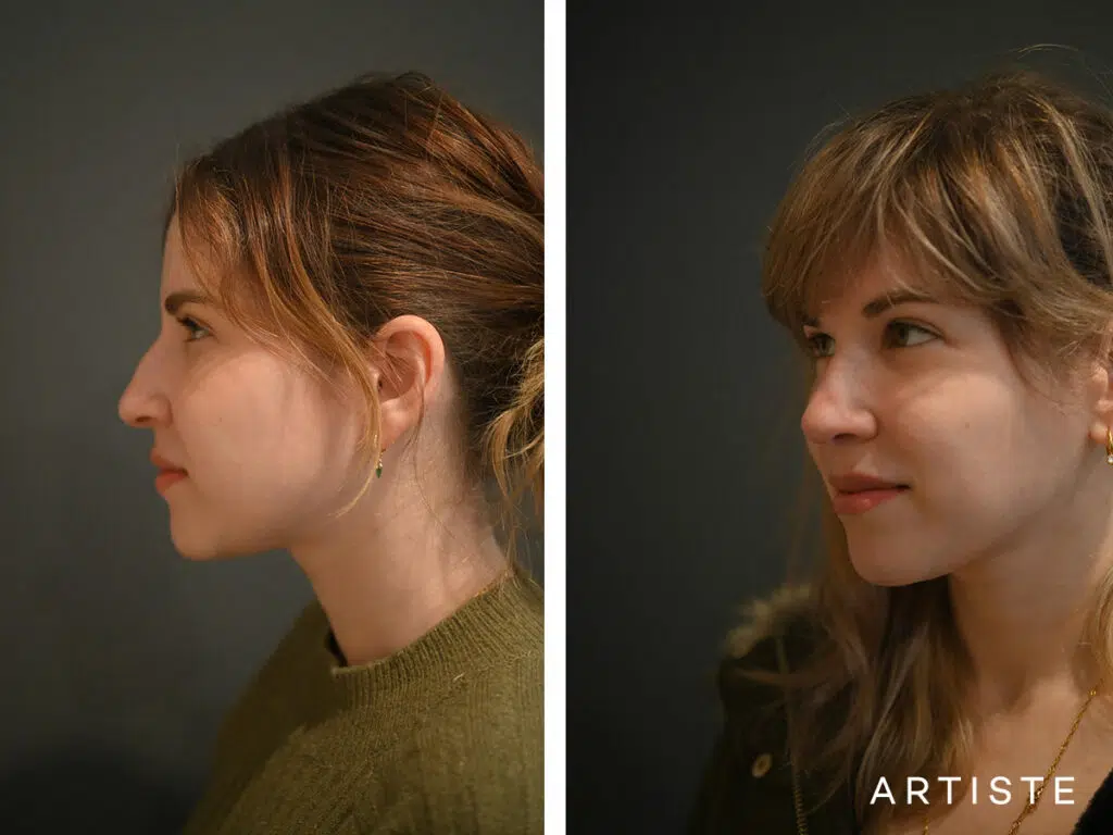 30 Years Old: Post Hybrid Stucture and Preservation Rhinoplasty