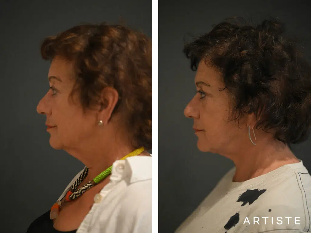 64 Years Old: Deep Plane Neck Lift